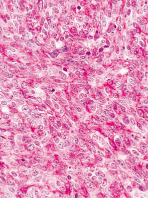 内分泌細胞癌（endocrine cell carcinoma）