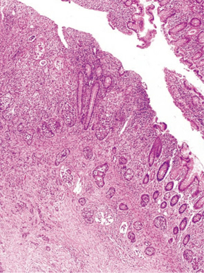 杯細胞カルチノイド（goblet cell carcinoid）