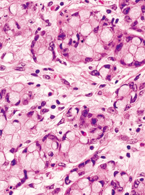 杯細胞カルチノイド（goblet cell carcinoid）