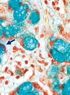 杯細胞カルチノイド（goblet cell carcinoid）